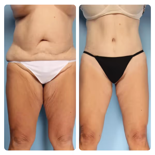 Thigh Lift in Turkey